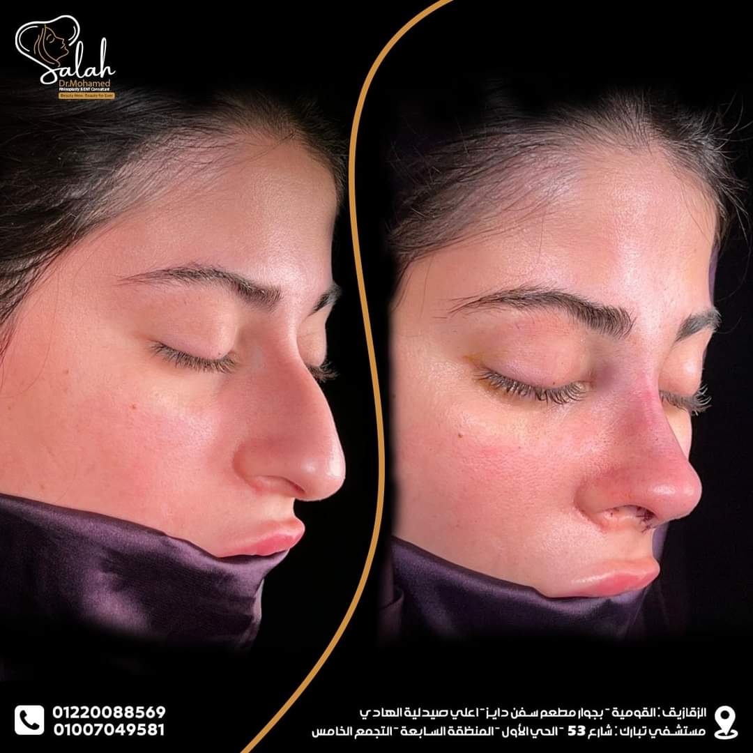 Droopy Tip Rhinoplasty